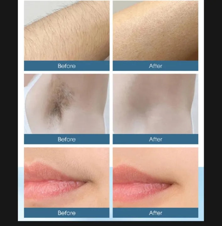 IPL Laser Hair Removal Device – Smooth Skin at Home