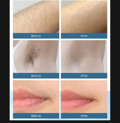 IPL Laser Hair Removal Device – Smooth Skin at Home