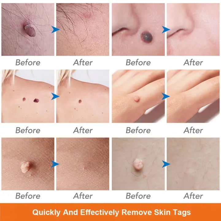 Laser Mole & Dark Spot Removal Pen
