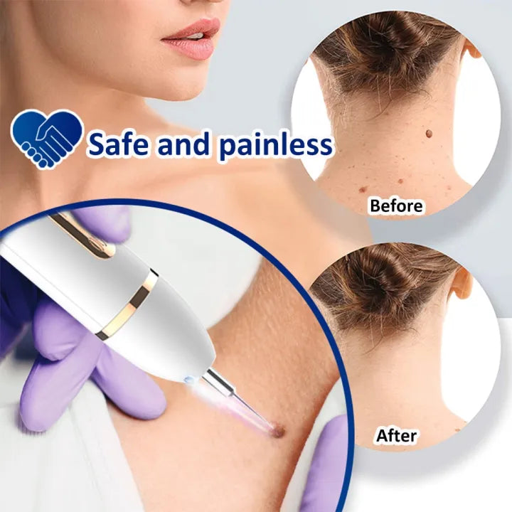 Laser Mole & Dark Spot Removal Pen