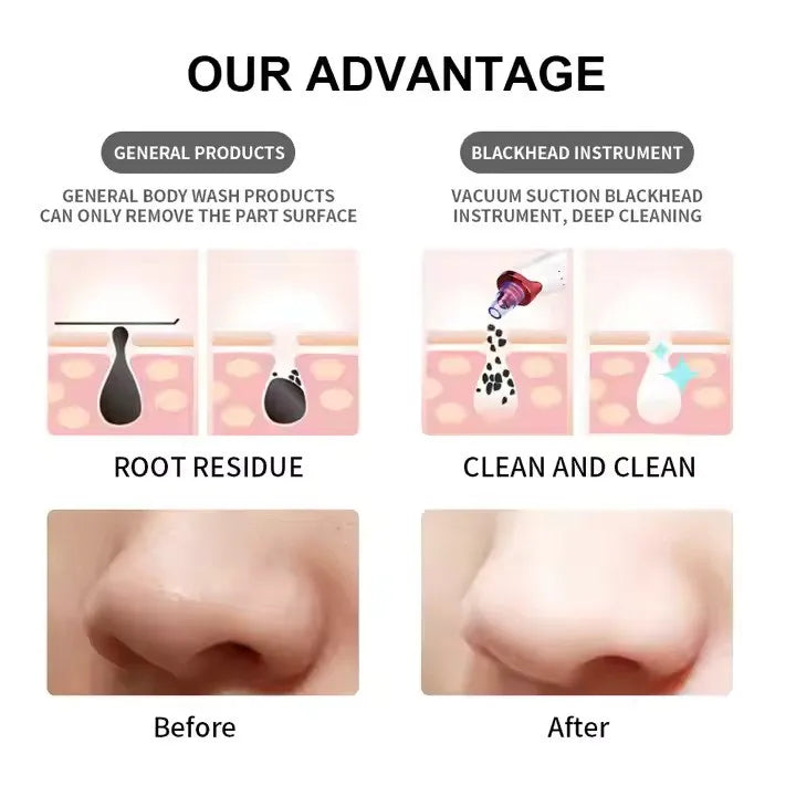 5 in 1 Electric Blackhead Remover