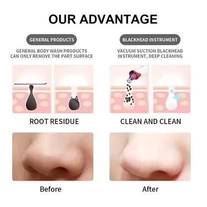 5 in 1 Electric Blackhead Remover