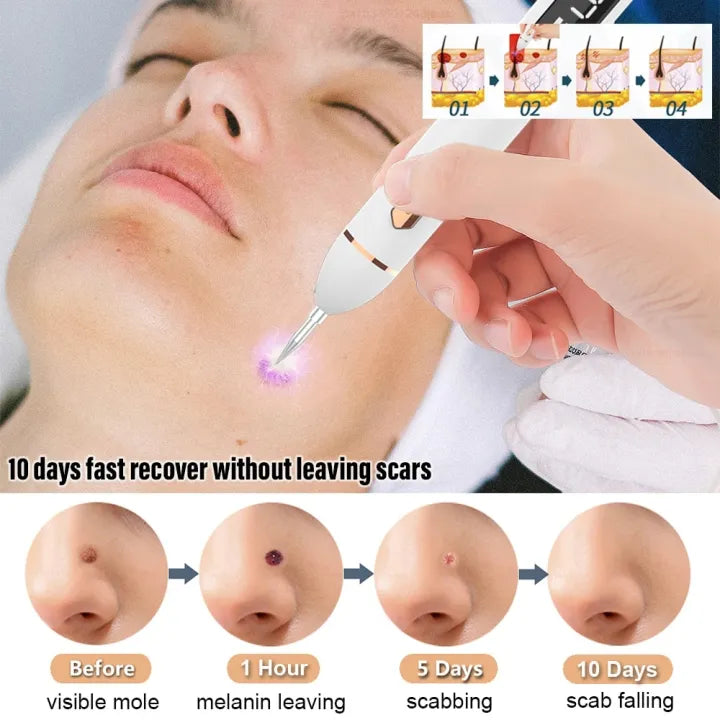 Laser Mole & Dark Spot Removal Pen