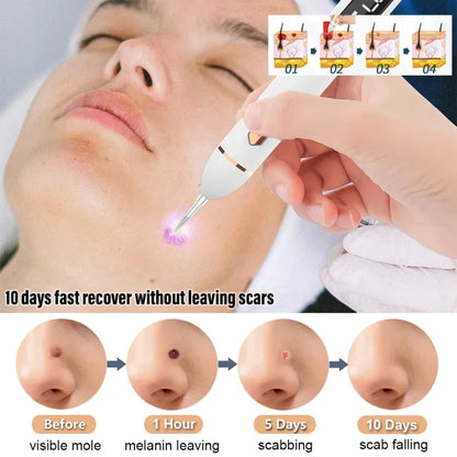 Laser Mole & Dark Spot Removal Pen